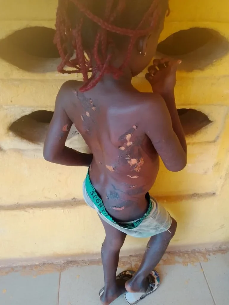 Mother Detained for Allegedly Burning Daughter With Hot Knife
